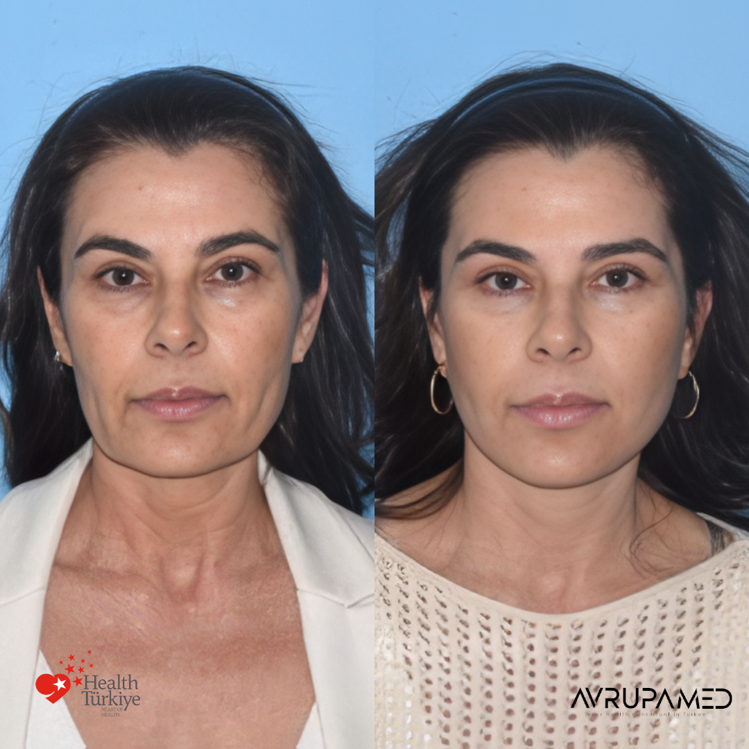 Neck Lift 1