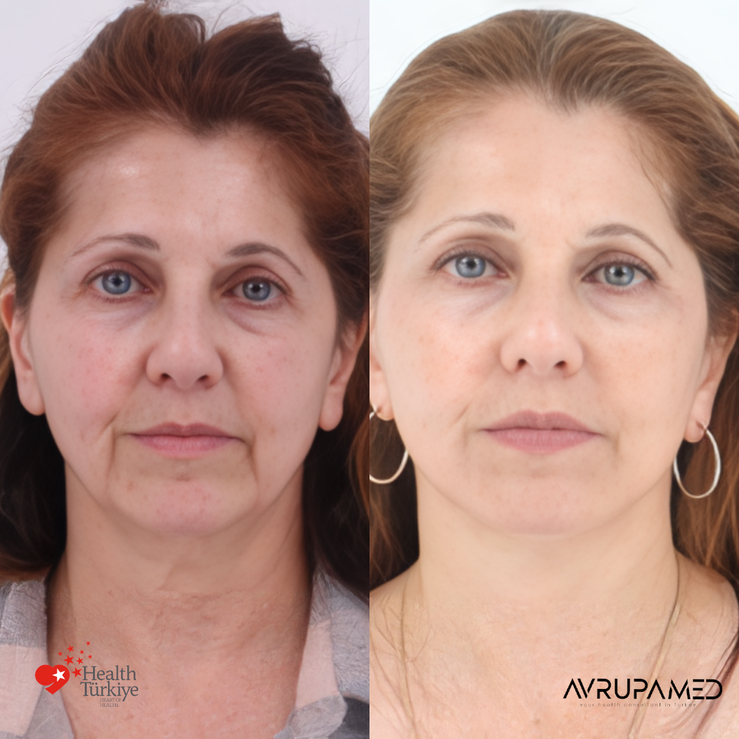 Neck Lift 2
