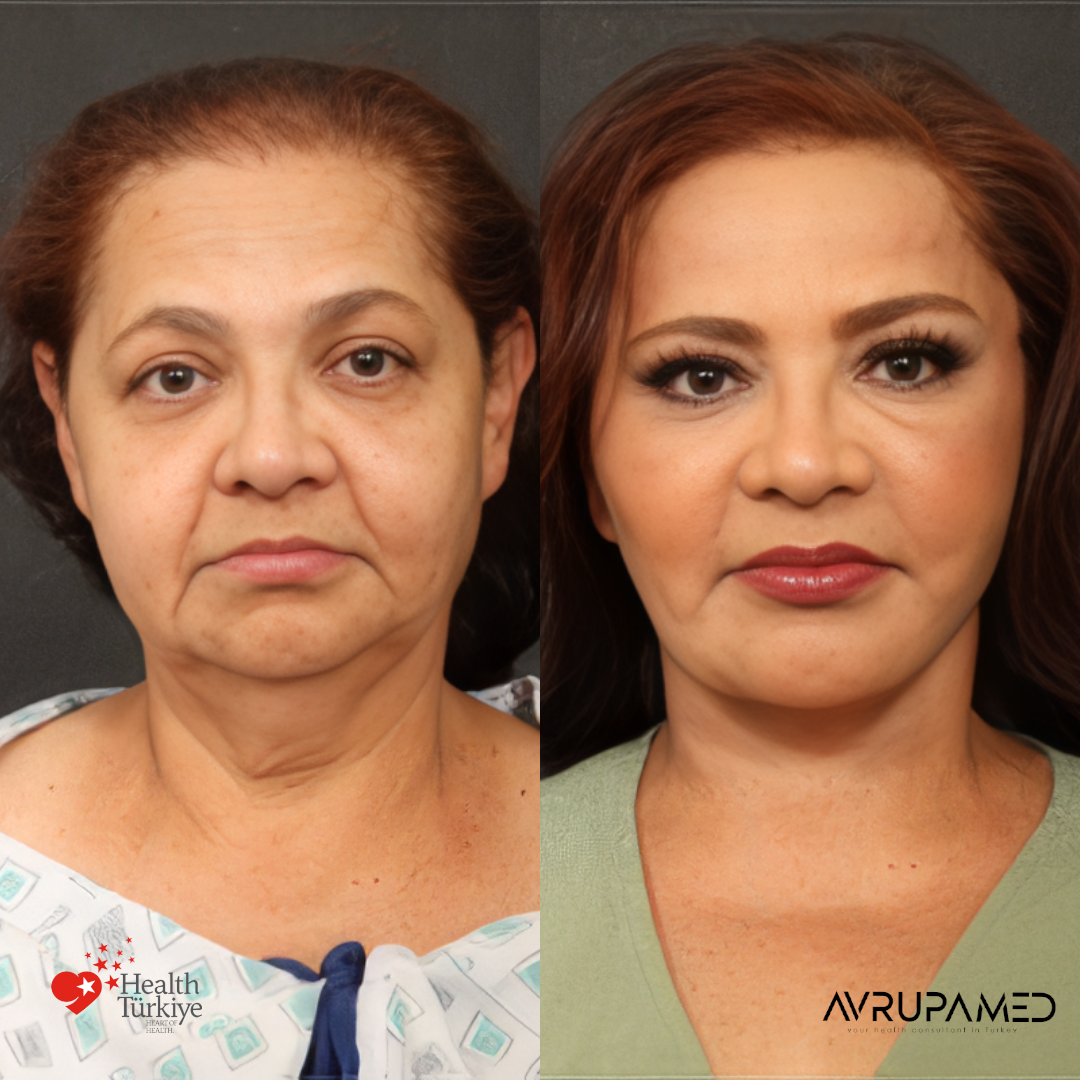 Neck Lift 3