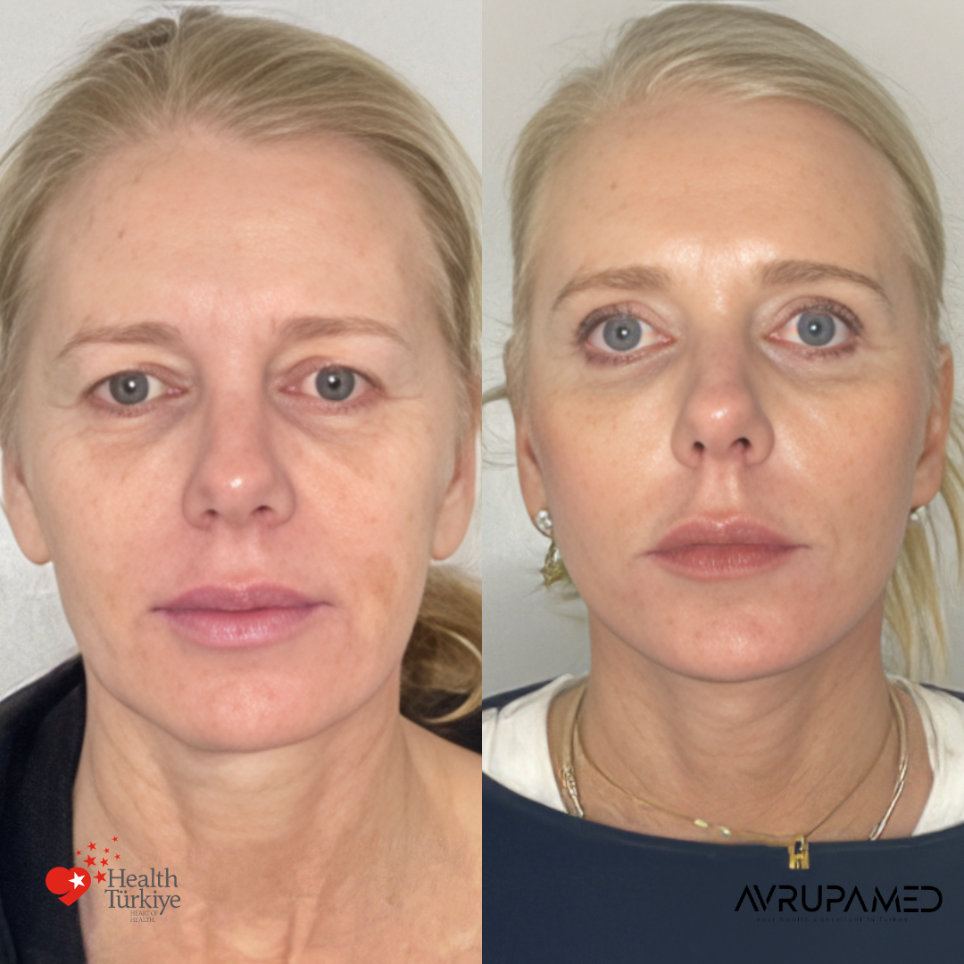 Neck Lift 5