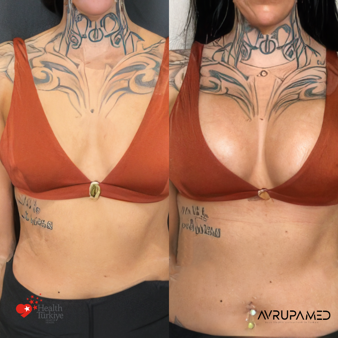 Breast Aesthetics in Turkey 33 Breast Implant 1