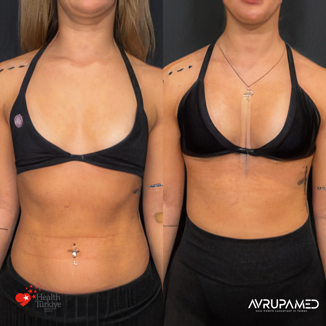 Breast Aesthetics in Turkey 32 Breast Implant 2