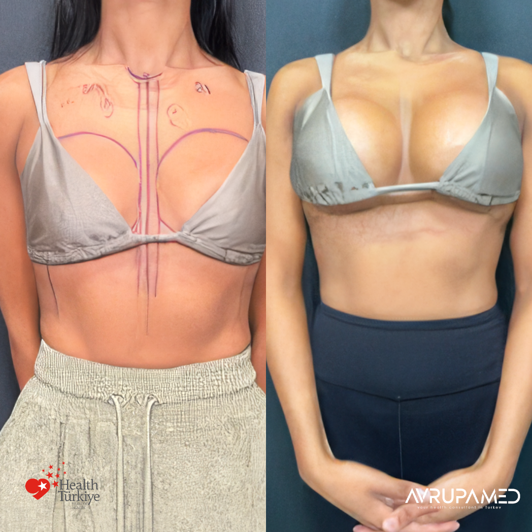 Breast Aesthetics in Turkey 31 Breast Implant 3