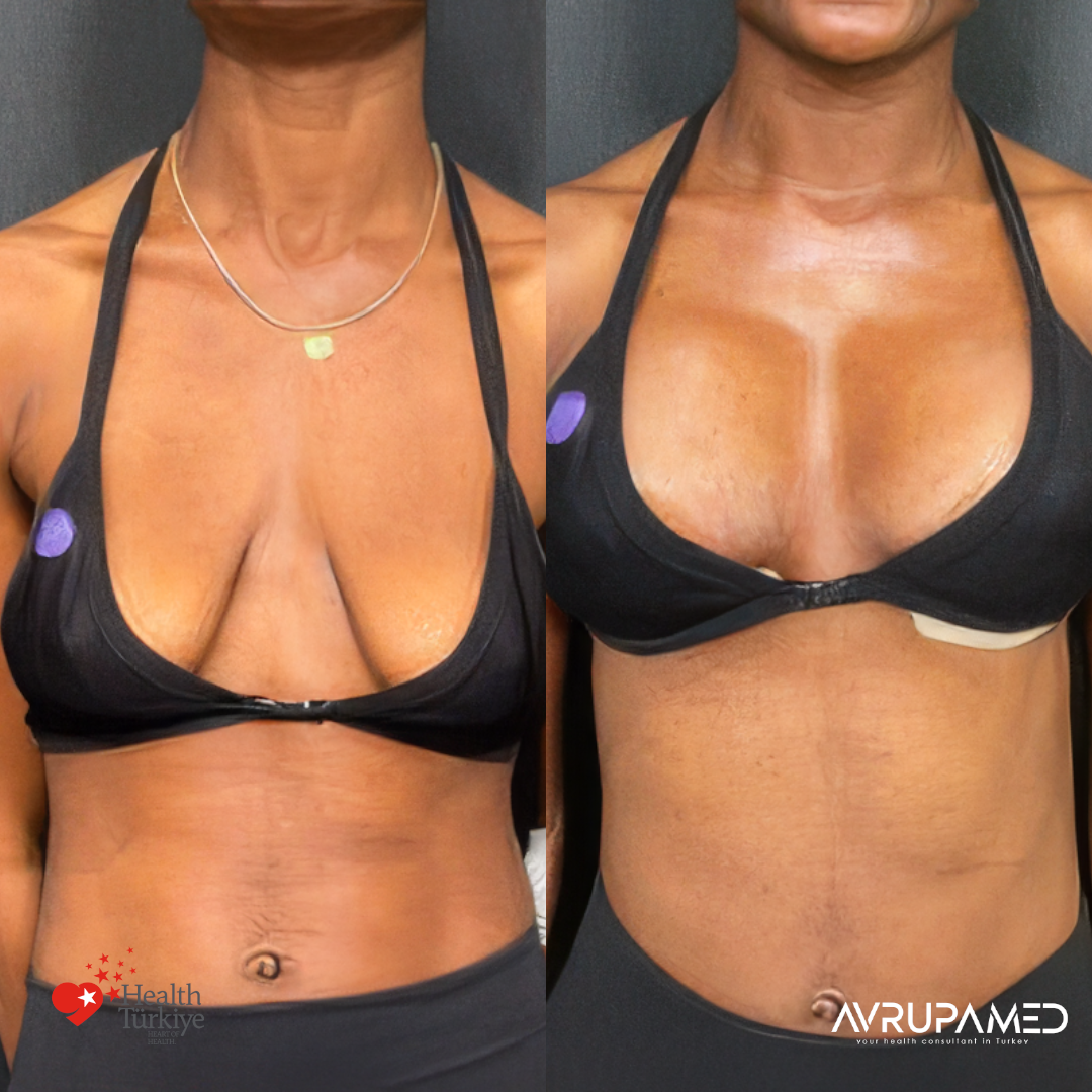 Breast Aesthetics in Turkey 30 Breast Lift Implant 1