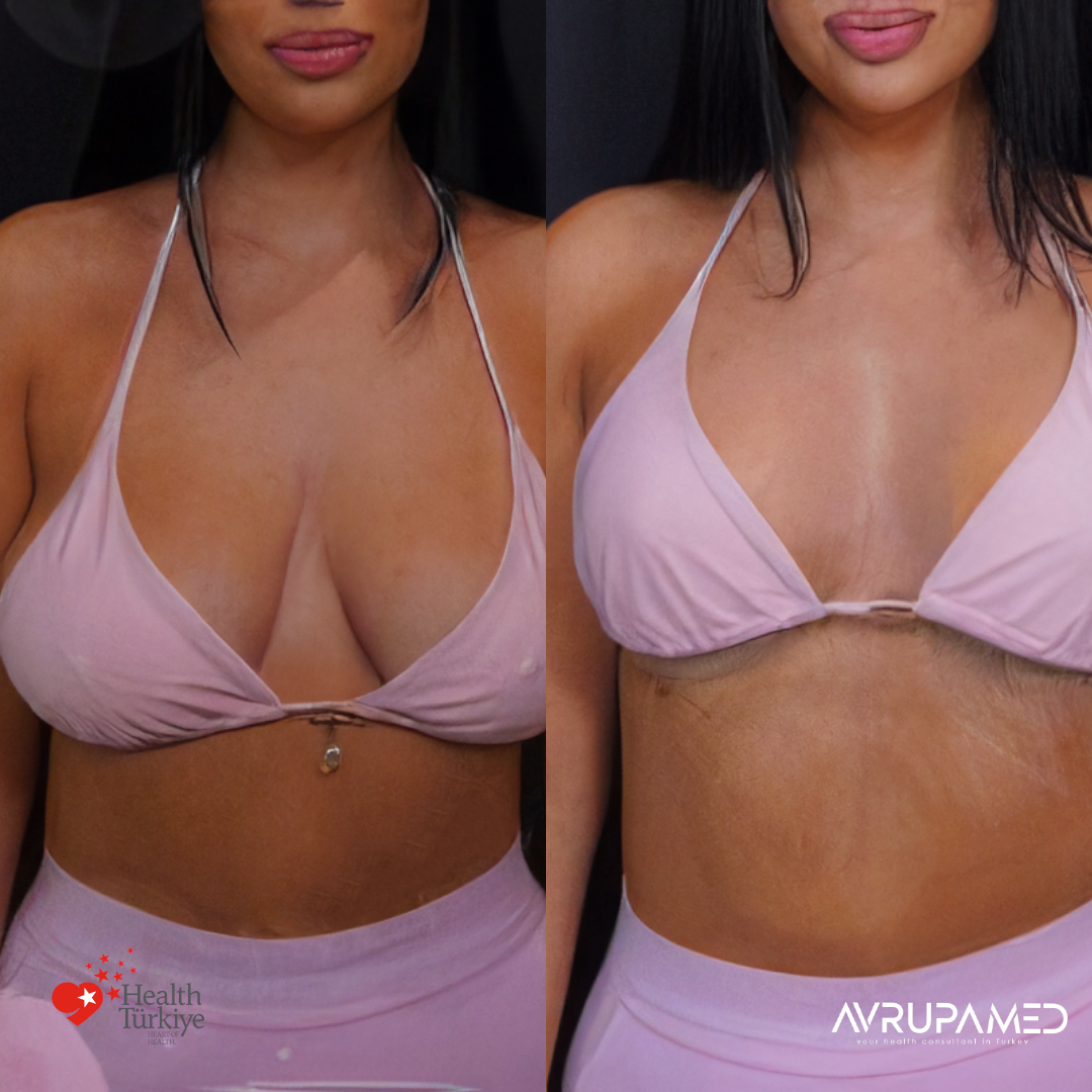 Breast Aesthetics in Turkey 29 Breast Lift Implant 2