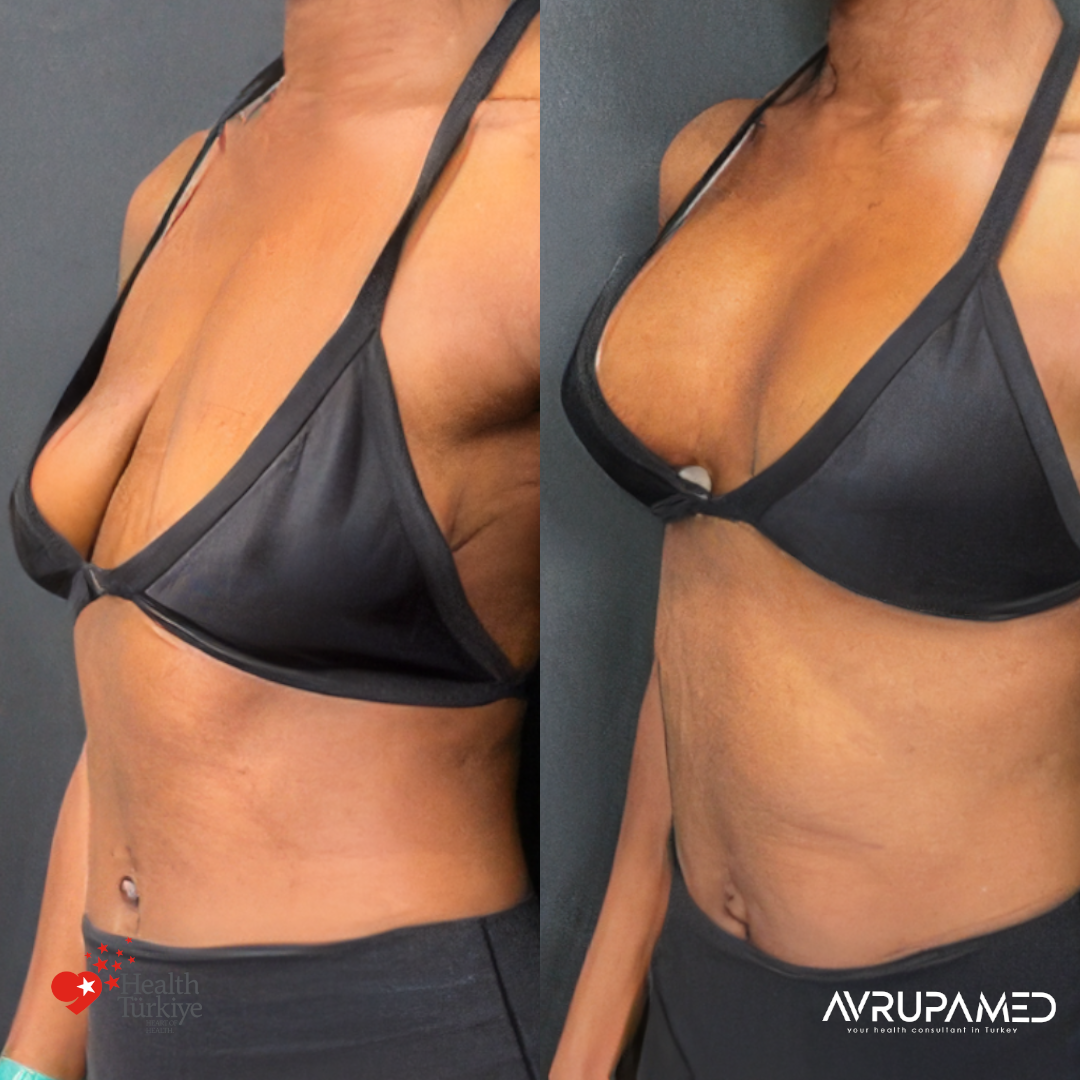 Breast Aesthetics in Turkey 28 Breast Lift Implant 3
